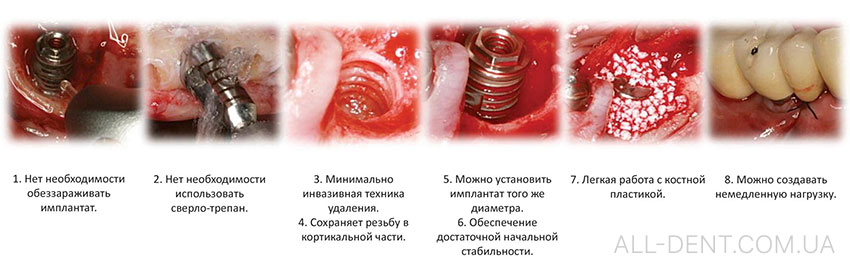 Выкручивание_имплантов_без_повреждения_кости