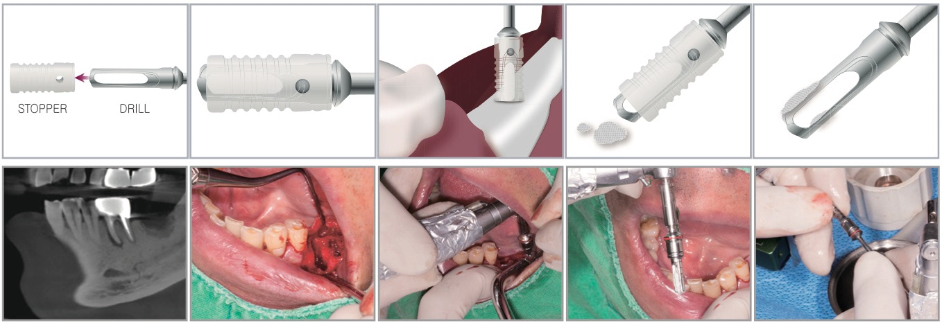 Dental Studio Bone Collektor применение