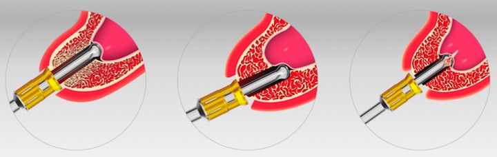 NeoBiotech_SCA_nabor