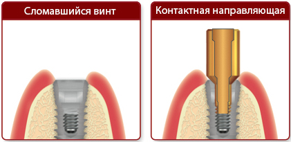 NeoBiotech набор для извлечения поврежденных винтов