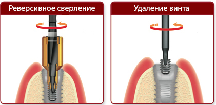 NeoBiotech набор для извлечения поврежденных винтов