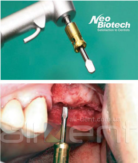 Костный-спредер-NeoBiotech.jpg