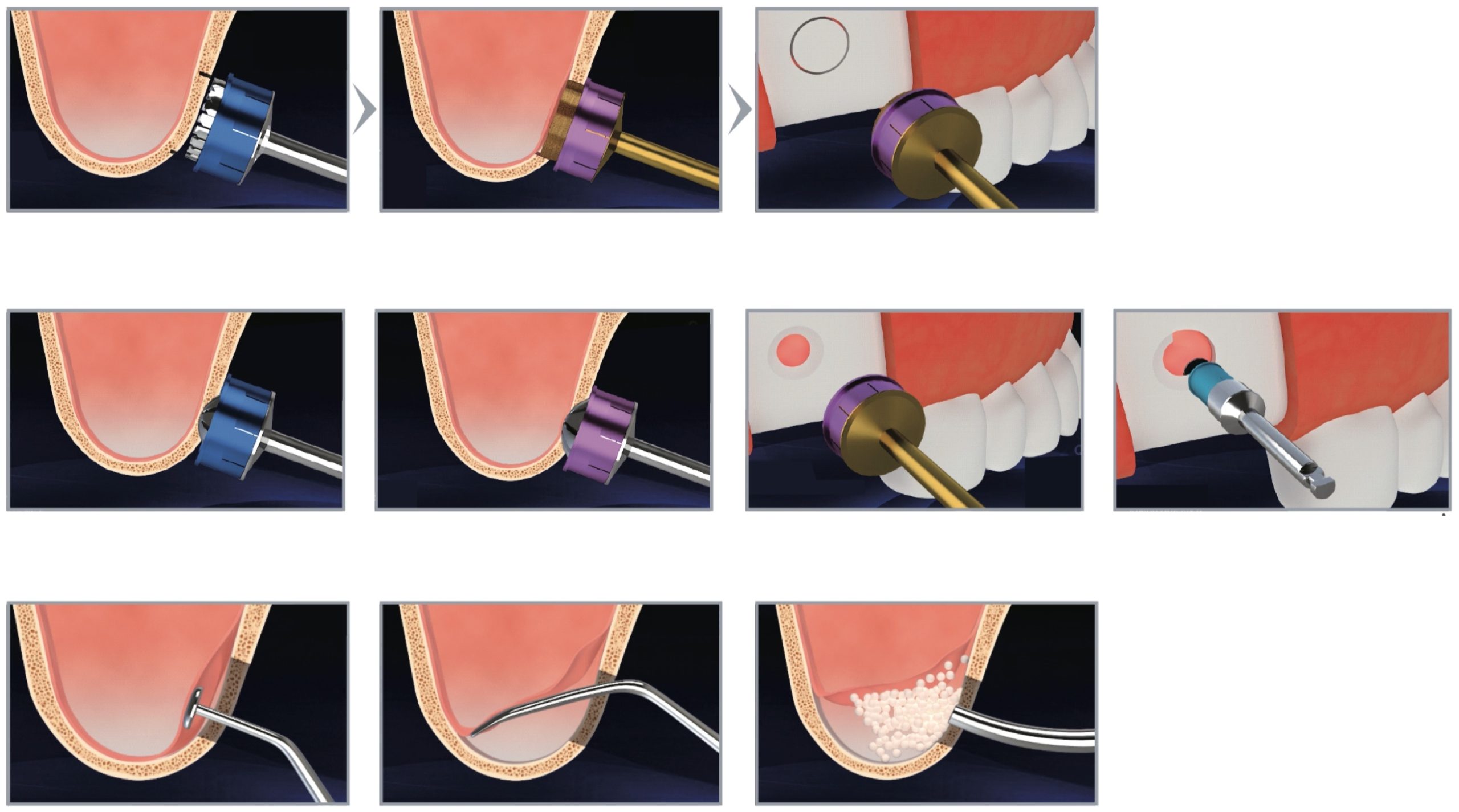 Набор Dental Studio Sinus Lateral Approach Kit
