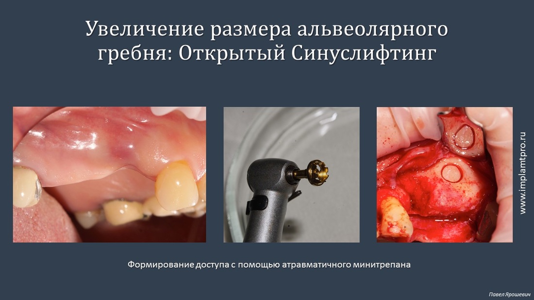 С-риммер_SLA_NeoBiotech_цена_в_Украине