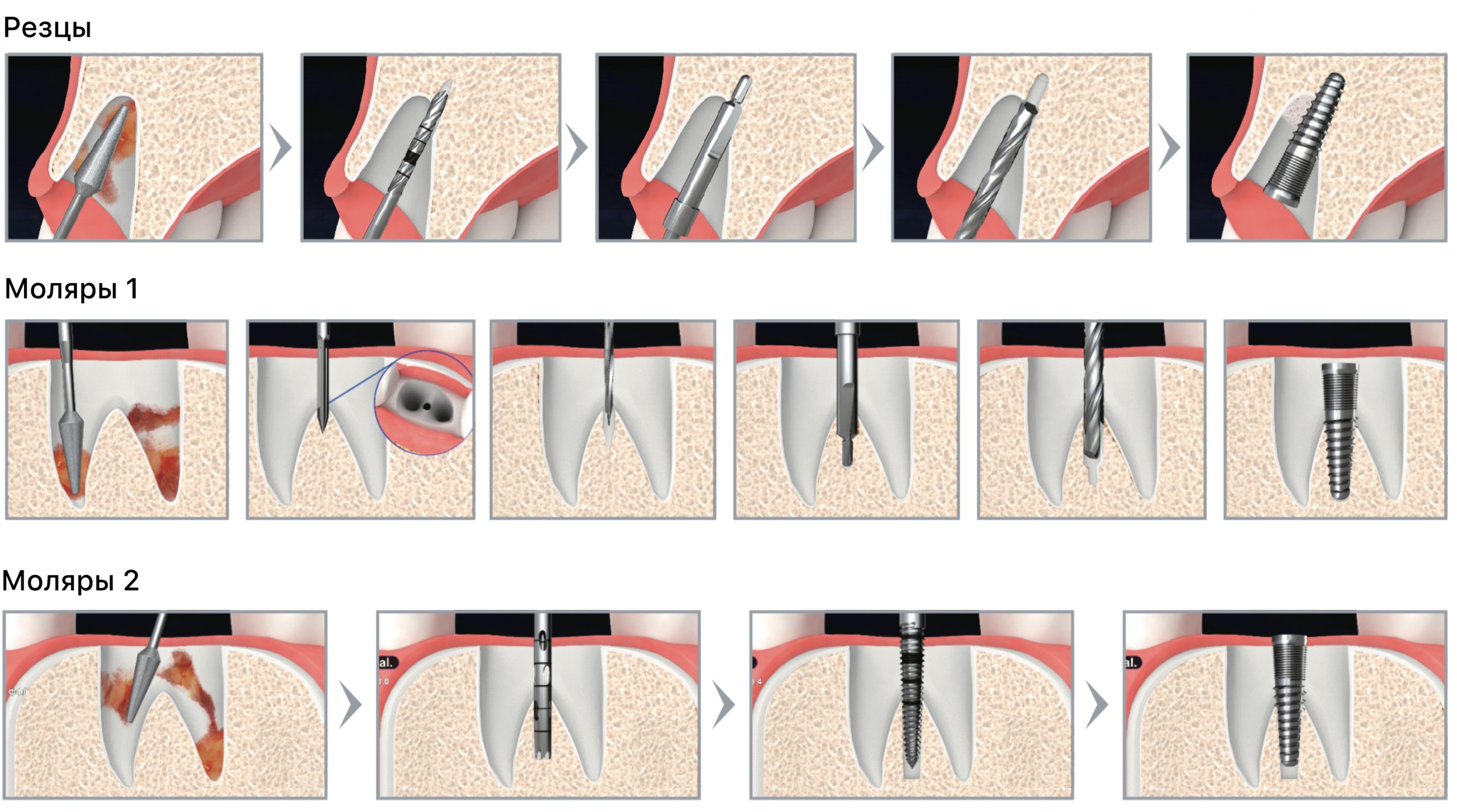 Хирургический набор тримеров Dental Studio