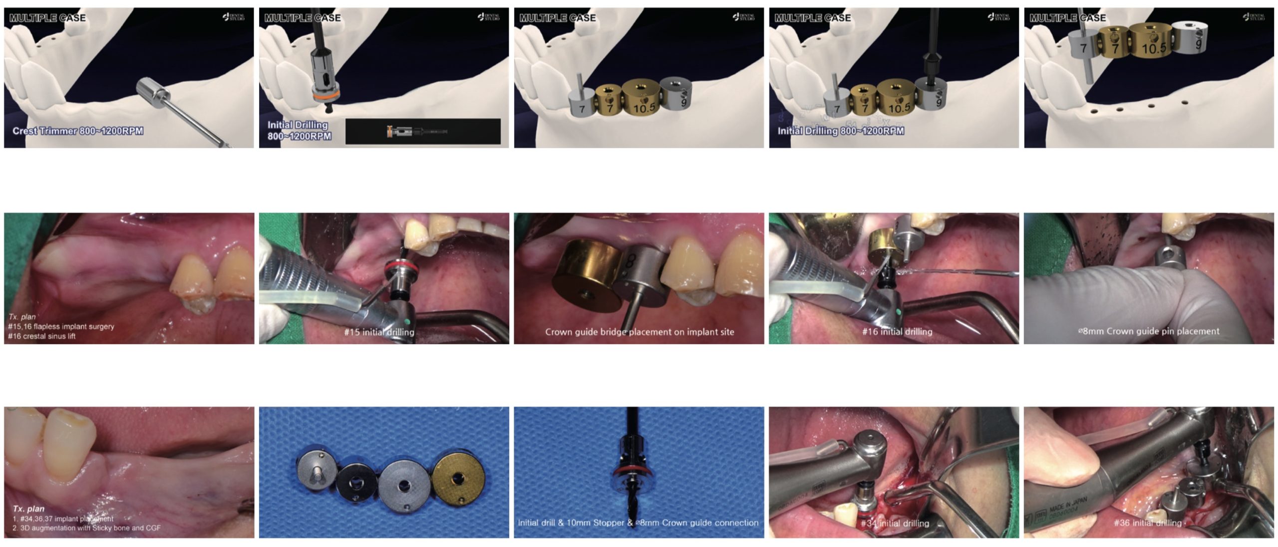 Техника применения Dental Studio Crown Guide Kit