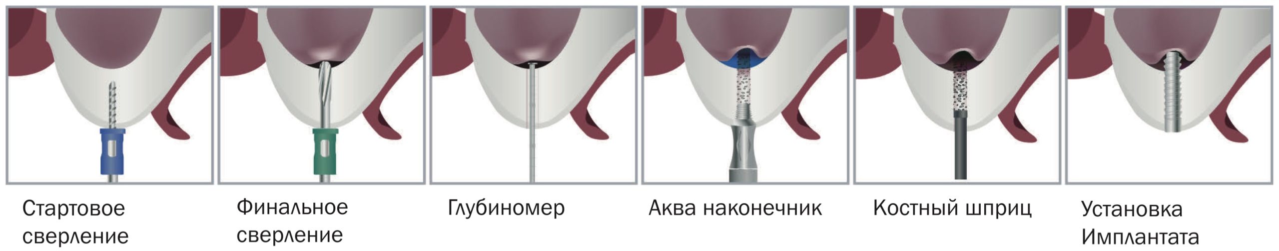 Техника применения Dental Studio Sinus Crestal Approach